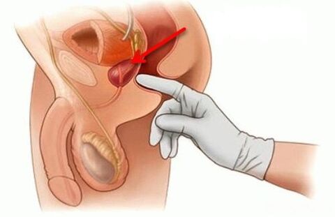 massaggio prostatico per prostatite