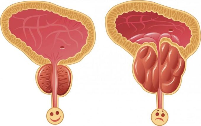 prostata sana e infiammata con prostatite